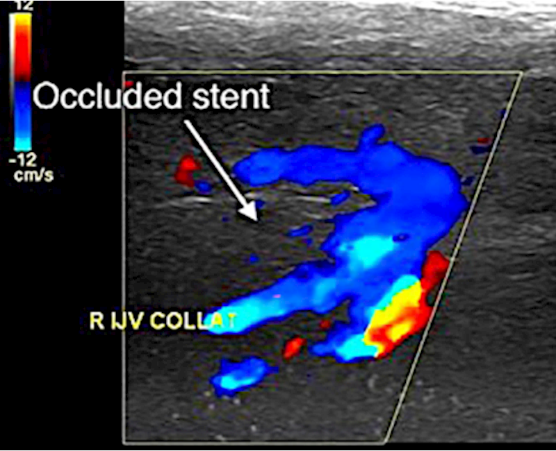 Eagle syndrome: A post-intervention vascular ultrasound case report